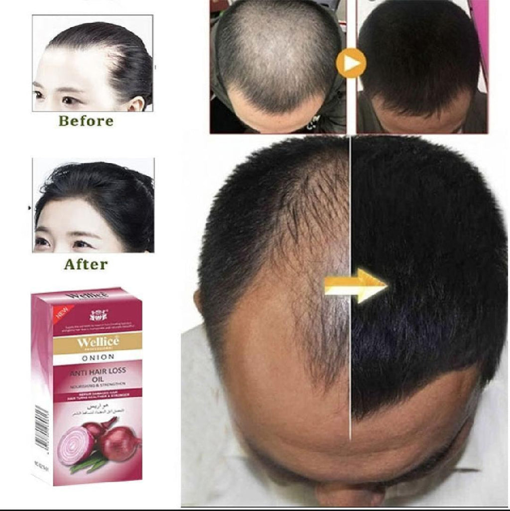 Wellice Onion Anti-Hair Loss Hair Oil 100ml Red Bottle